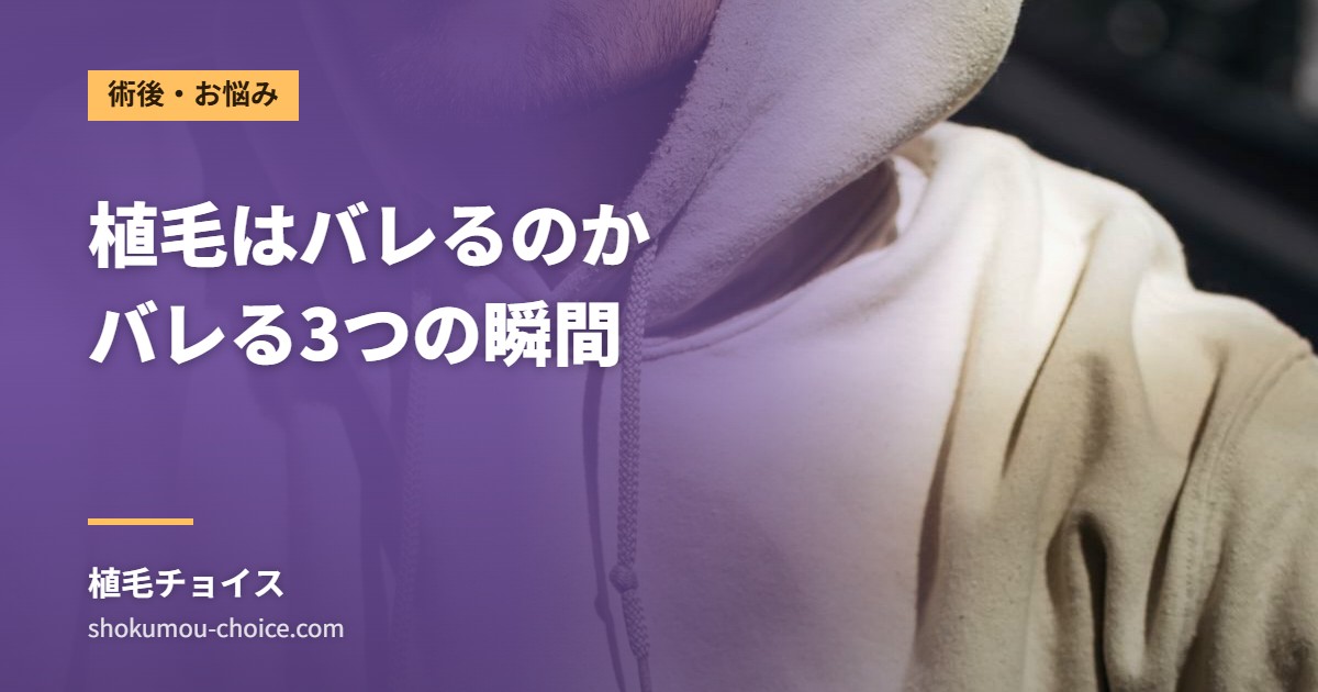 植毛はバレるのか バレる3つの瞬間